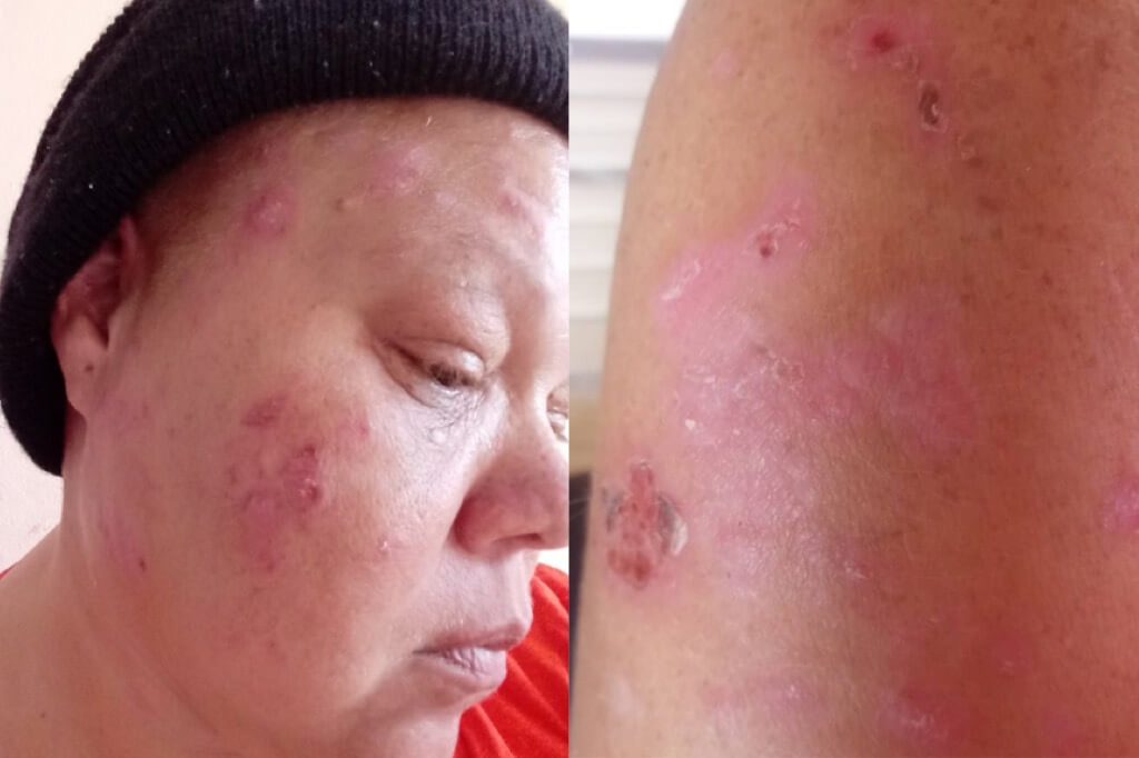 Ciudadana pide ayuda económica para tratar su enfermedad de Pénfigo